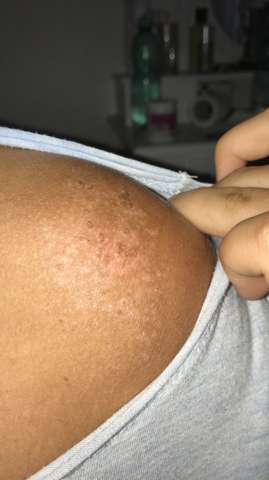 Angst Das Das Hautkrebs Sein Konnte Sonnenbrand Angst Das Das Hautkrebs Sein Konnte Sonnenbrand