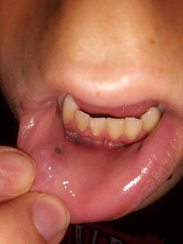 Pic-3 - (Piercing, Entzündung, Stecker)