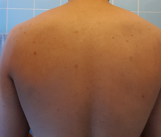 Angst Mich Mit Hiv Infiziert Zu Haben Kennt Sich Jemand Aus Gesundheit Und Medizin Gesundheit Ausschlag Angst Mich Mit Hiv Infiziert Zu Haben Kennt Sich Jemand Aus Gesundheit Und Medizin Gesundheit Ausschlag