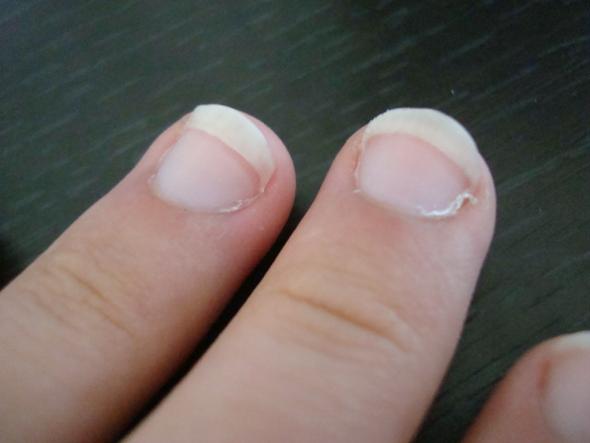 angst um meine fingernagel nagel kauen 
