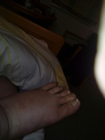 Mein Fuß gestern abend - (Gesundheit, krank, Diabetes)