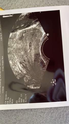 Angst Vor Fehlgeburt Wie Kann Ich Das Andern Schwangerschaft Angst Vor Fehlgeburt Wie Kann Ich Das Andern Schwangerschaft