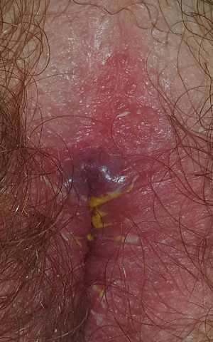 Habe Am After Komische Rotungen Und Gelben Ausfluss Was Konnte Das Sein Achtung Bild Gesundheit Arzt Schmerzen Habe Am After Komische Rotungen Und Gelben Ausfluss Was Konnte Das Sein Achtung Bild Gesundheit Arzt Schmerzen
