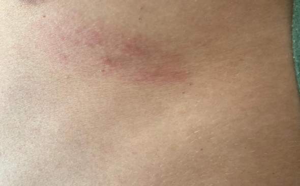 Anzeichen Gurtelrose Gesundheit Und Medizin Heilung Selbsthilfe Anzeichen Gurtelrose Gesundheit Und Medizin Heilung Selbsthilfe