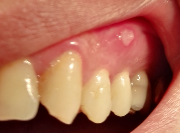 Aphte Geht Nicht Weg Fistel Gesundheit Und Medizin Zahnarzt Mundhygiene Aphte Geht Nicht Weg Fistel Gesundheit Und Medizin Zahnarzt Mundhygiene