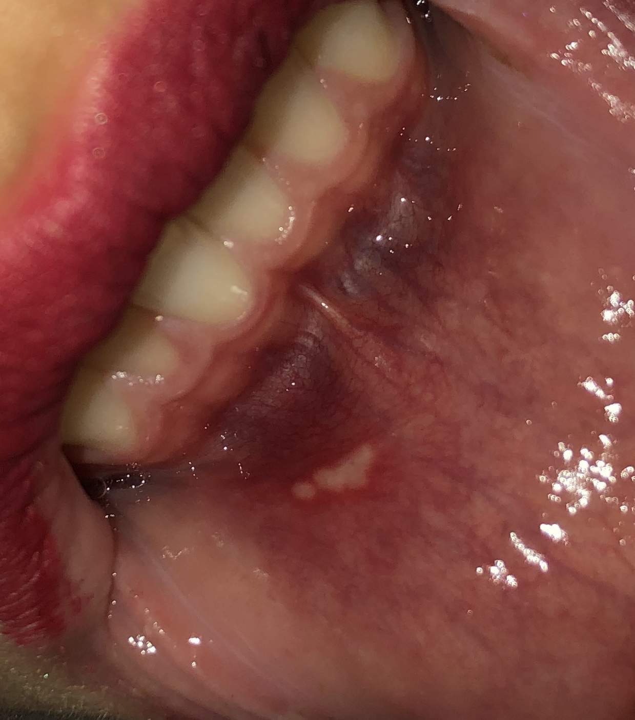 aphte oder doch was anderes? (Medizin, Freunde, Zahnmedizin)