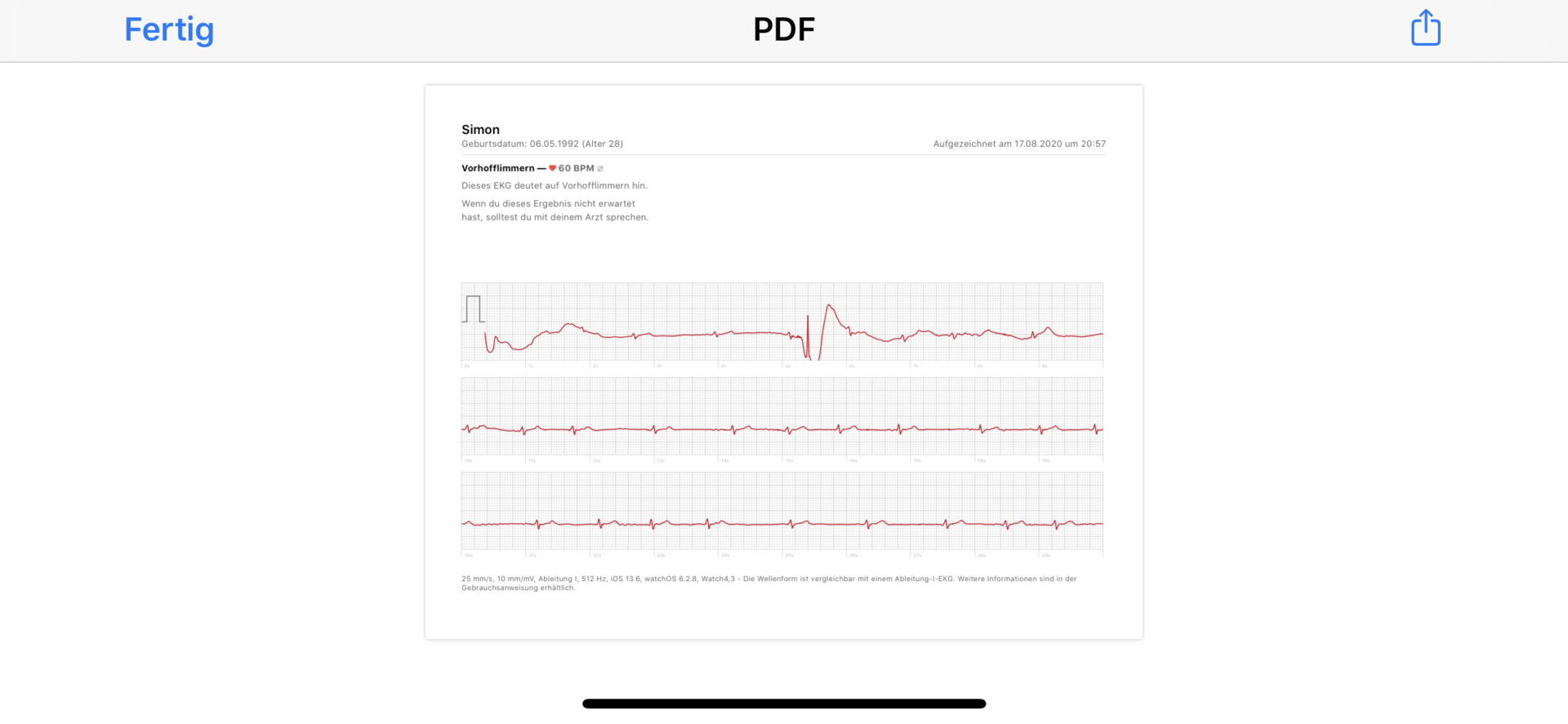 Apple Watch EKG Vorhofflimmern? (Herz)