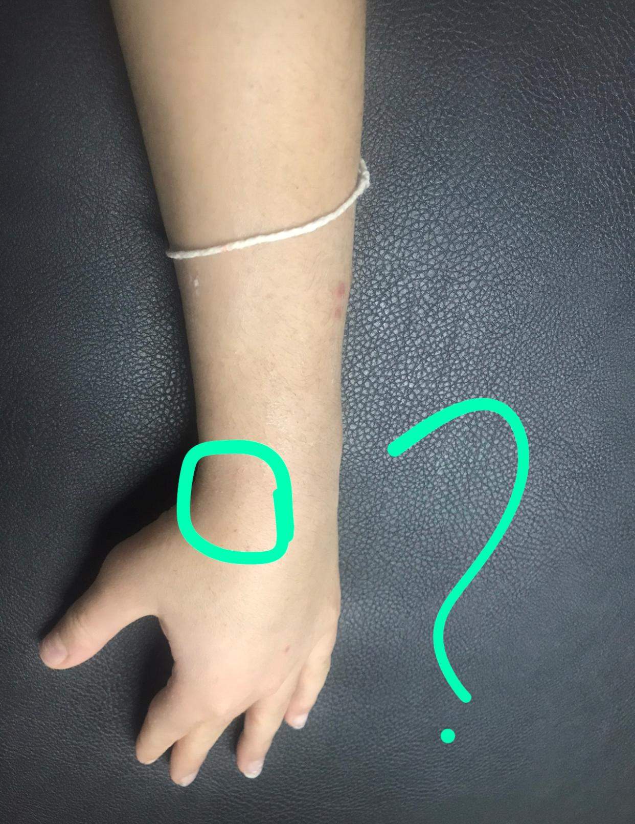 Arm gebrochen und jetzt ist es komisch nach dem gips abgenomme wurde