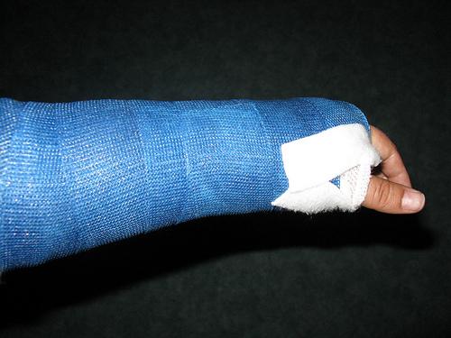 Wie bein lange gips gebrochen Laufen nach