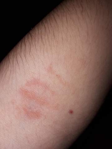 Arm Nach Blutabnahme Ist Das Normal Gesundheit Und Medizin Blutabnehmen Arm Nach Blutabnahme Ist Das Normal Gesundheit Und Medizin Blutabnehmen