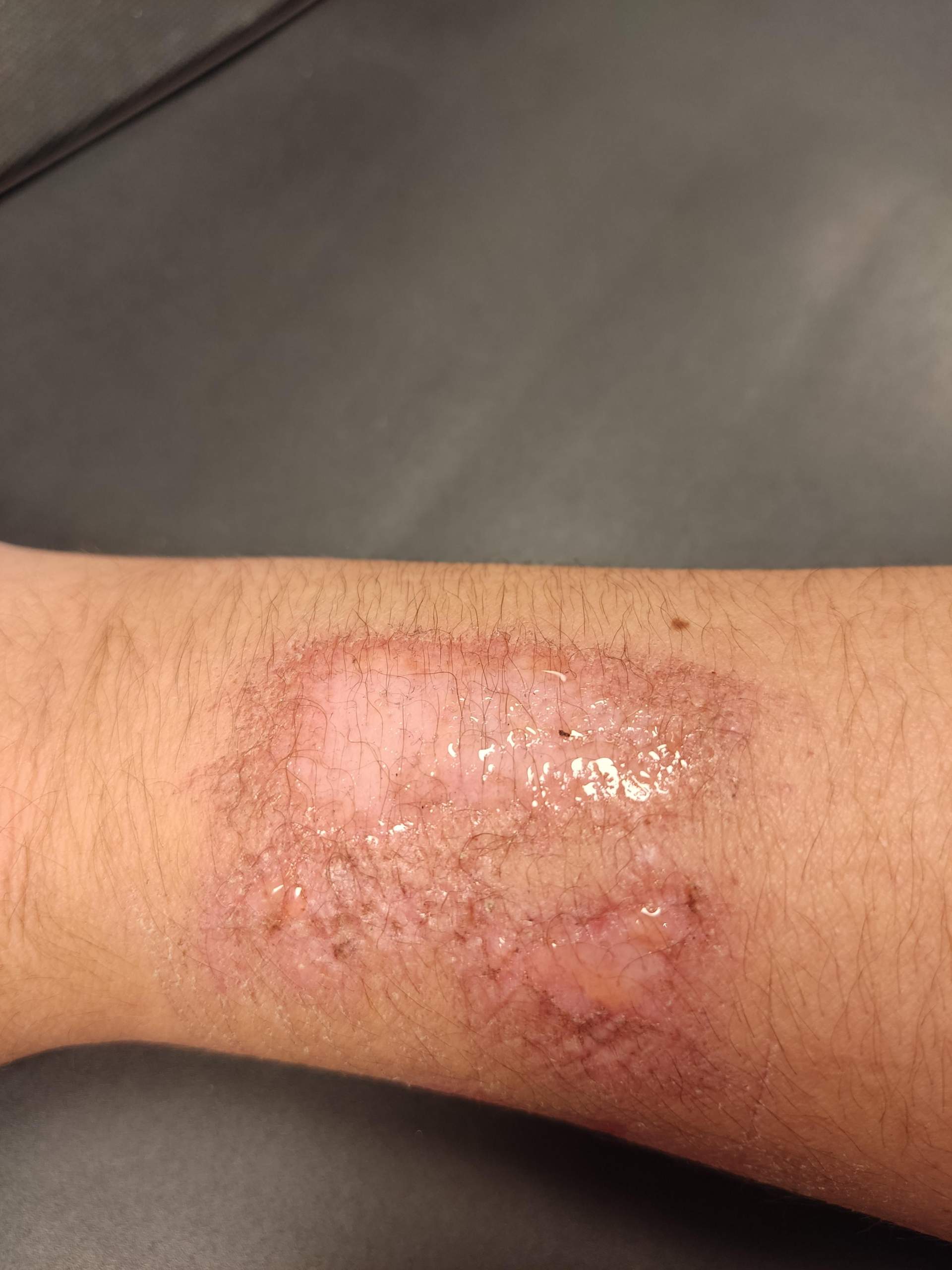 Arm verbrannt, was machen? (Gesundheit und Medizin, Verletzung