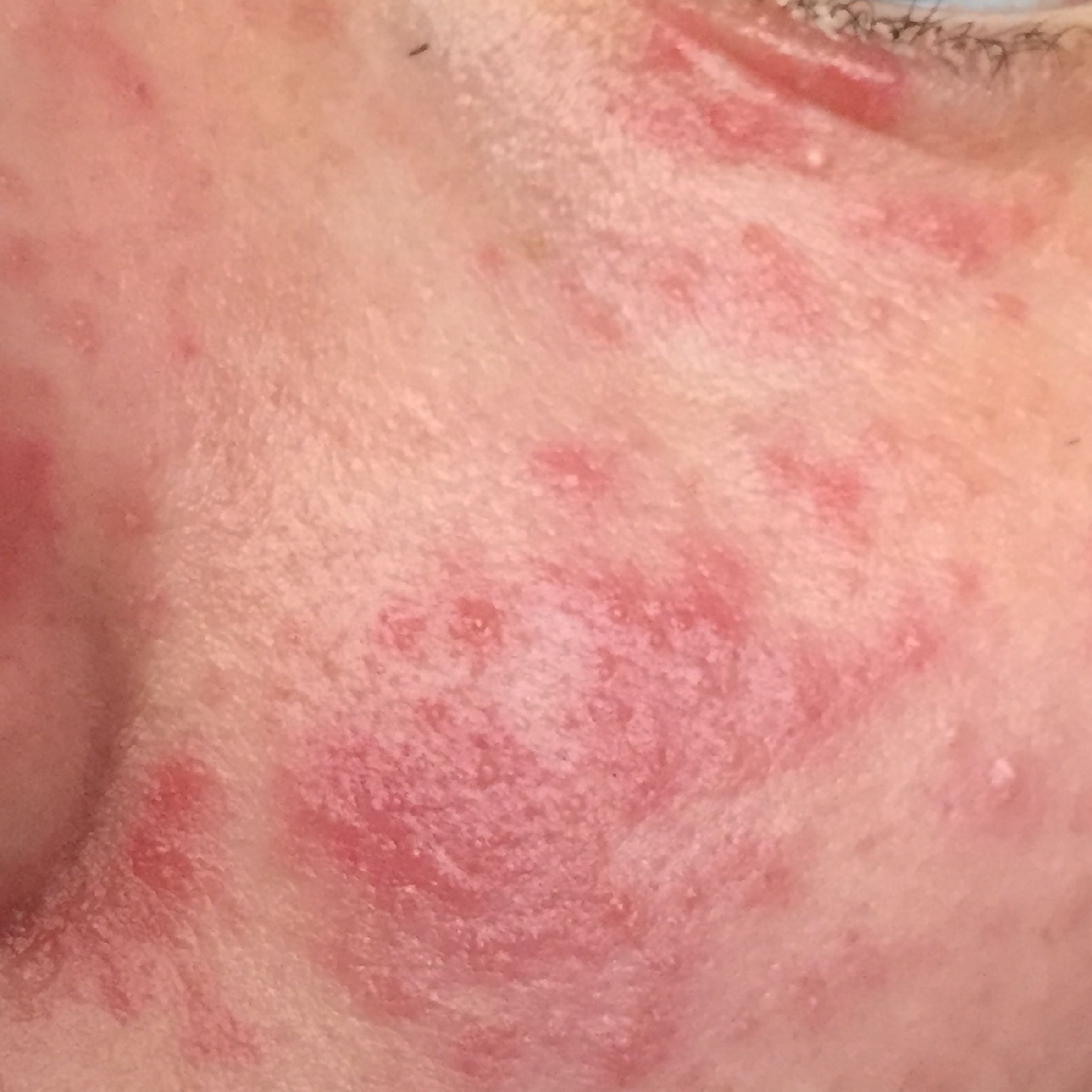 Pickel im gesicht vom zahnen pickel im gesicht rasieren