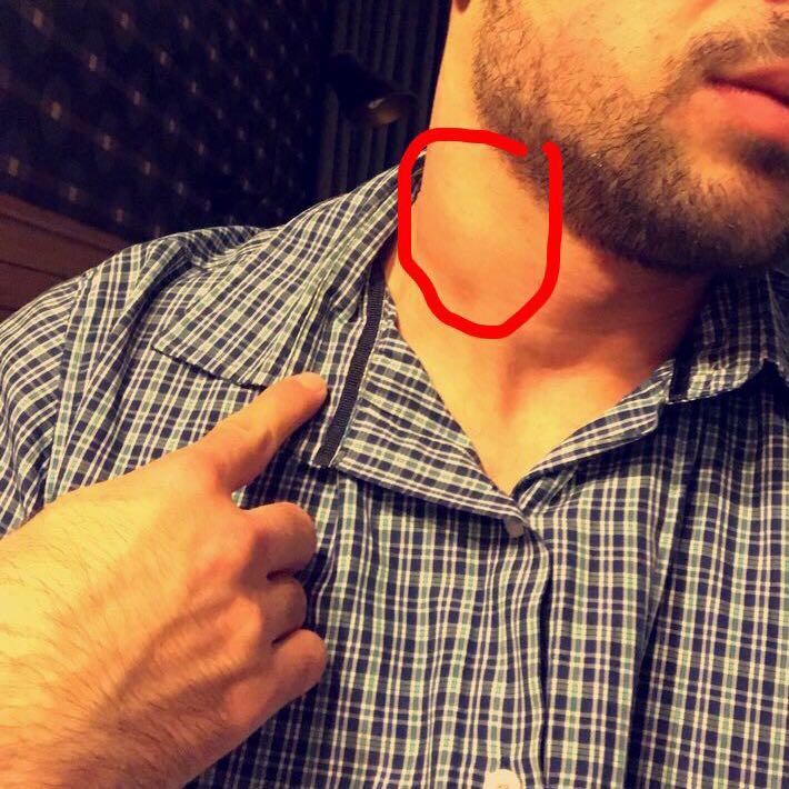 Arzt sagt es ist ein halsmuskel aber ich finde es sieht Arzt sagt es ist ein halsmuskel aber ich finde es sieht