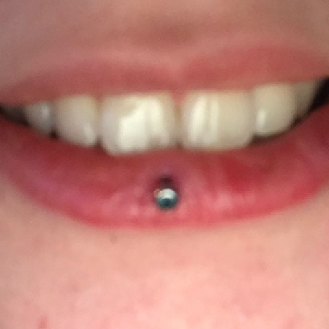 Hier ein Bild (ich hoffe man erkennt die Schwellung) - (Gesundheit und Medizin, Piercing, Lippe)