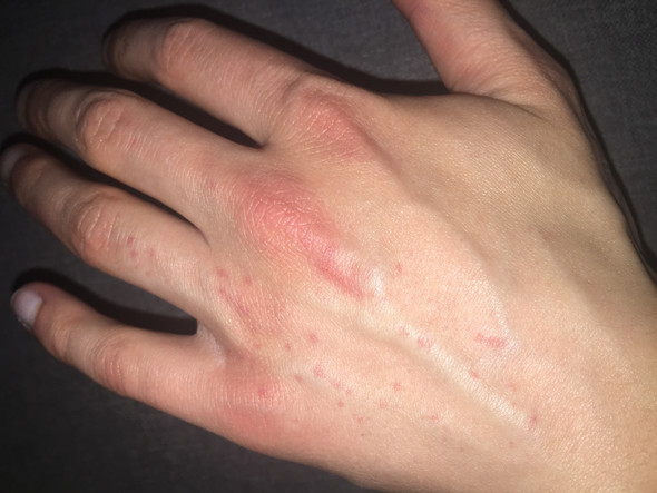 Auf der Hand risse und rote Punkte, Ausschlag? ( mit Bild ), was ist
