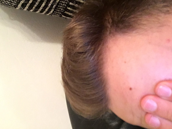 viel weniger haare woran liegt