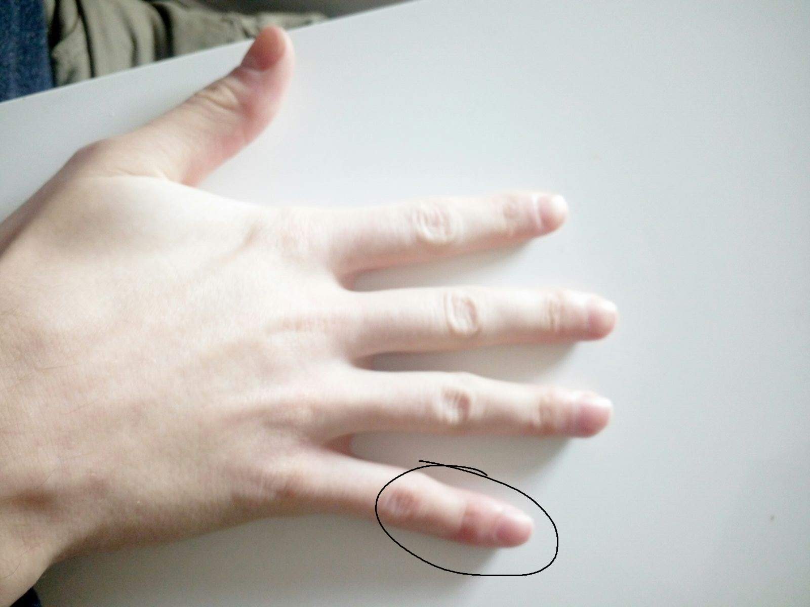 Auf einmal Finger Schwellung? (Arzt, Fingernägel)
