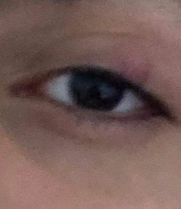 Auf Linke Auge Verschwommen Gesundheit Und Medizin Gesundheit Medizin Auf Linke Auge Verschwommen Gesundheit Und Medizin Gesundheit Medizin