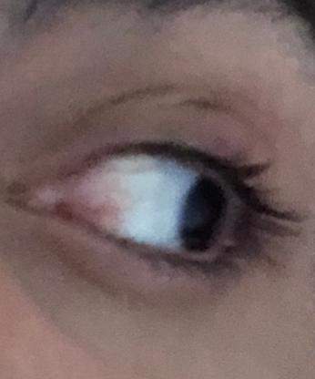 Auf Linke Auge Verschwommen Gesundheit Und Medizin Gesundheit Medizin Auf Linke Auge Verschwommen Gesundheit Und Medizin Gesundheit Medizin