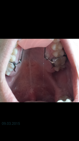 Die Aufbissplatte - (Zahnarzt, Zahnspange, Kieferorthopädie)