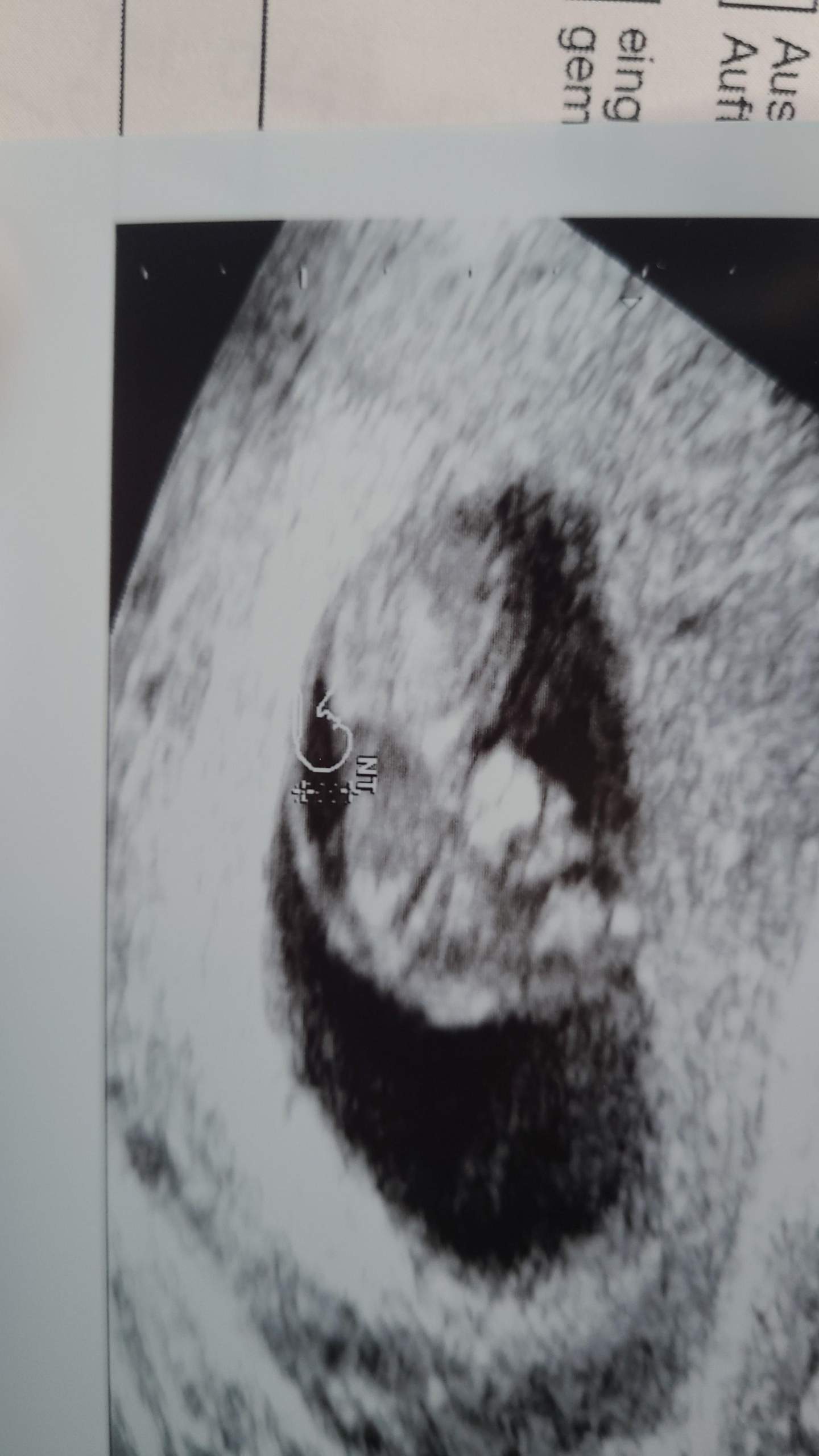 Auff llige Nackenfalte Schwangerschaft Gyn kologe Untersuchung auff-llige-nackenfalte-schwangerschaft-gyn-kologe-untersuchung