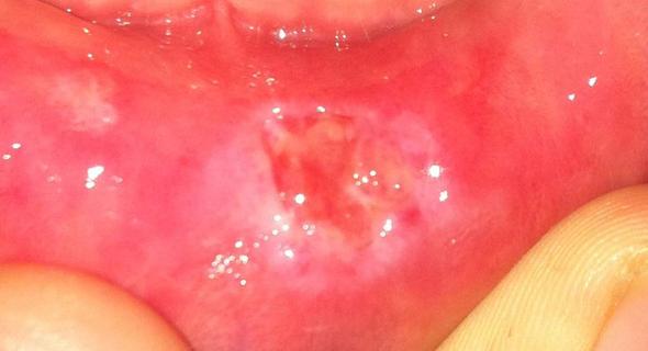 Meine Aufgebissene Wunde An Lippe Heilt Nicht Ist Das Normal Schmerzen Mund