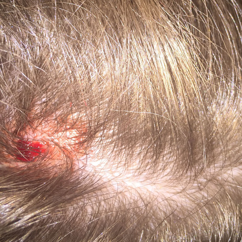 Aufkratzen Von Wunde Gesundheit Und Medizin Arzt Kratzen