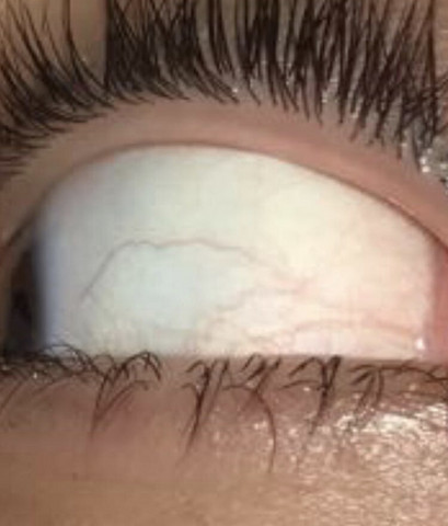 Augapfel Farbe Ist Das Normal Augen