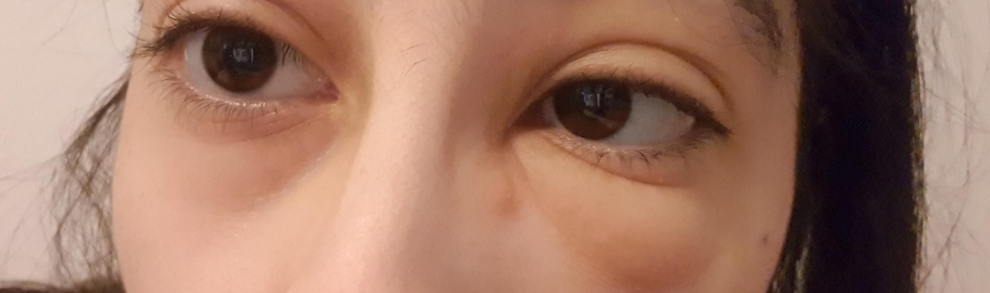 Auge Angeschwollen Nach Insektenstich Und Salbe Gesundheit Und Medizin Medizin Augen Auge Angeschwollen Nach Insektenstich Und Salbe Gesundheit Und Medizin Medizin Augen