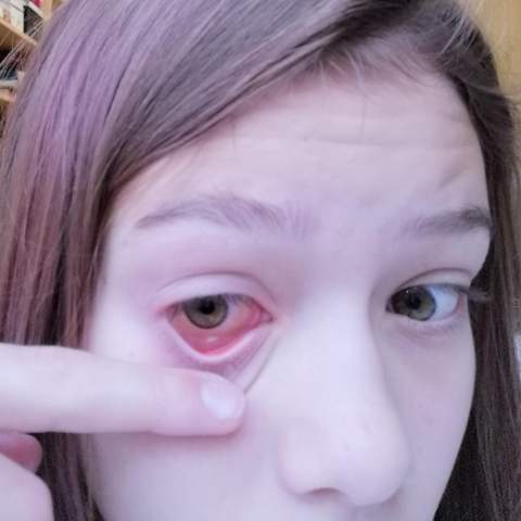 Auge Juckt Furchterlich Was Habe Ich Gesundheit Augen Juckreiz Auge Juckt Furchterlich Was Habe Ich Gesundheit Augen Juckreiz