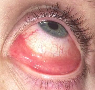 Auge Juckt Ist Rot Tut Weh Und Angeschwollen Bindehautentzundung Schwellung Rote Augen Auge Juckt Ist Rot Tut Weh Und Angeschwollen Bindehautentzundung Schwellung Rote Augen