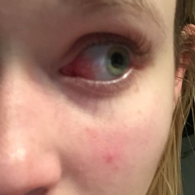 Auge juckt und ist rot? (Frauen, Schmerzen, Krankheit)