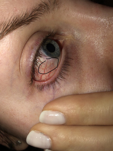 Auge Komisches Weisses Ding Drin Augen Kontaktlinsen Rote Augen Auge Komisches Weisses Ding Drin Augen Kontaktlinsen Rote Augen