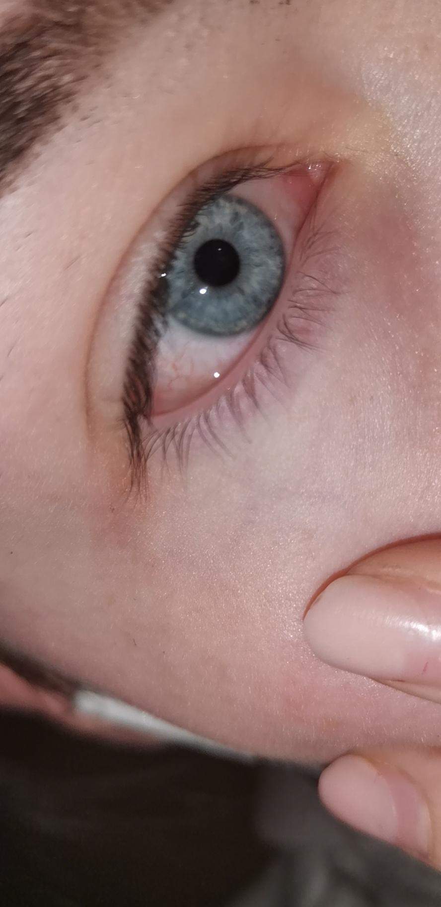Auge /Lederhaut? (Gesundheit und Medizin, Krankheit, Augen)