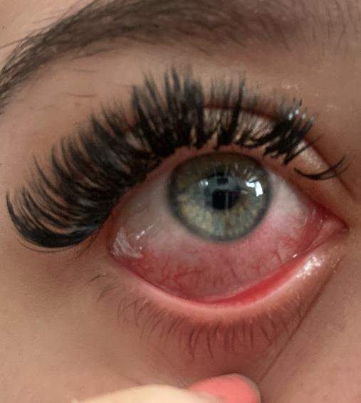 Auge rot nach wimpernverlngerung? (Augen, Wimpern)