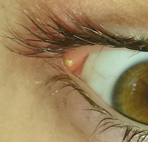 Auge1 - (Schmerzen, Augen, Verletzung)