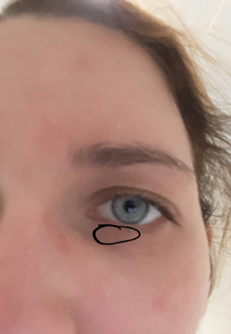 Auge Schmerzt Gegenstand Schmerzen Augen Auge Schmerzt Gegenstand Schmerzen Augen