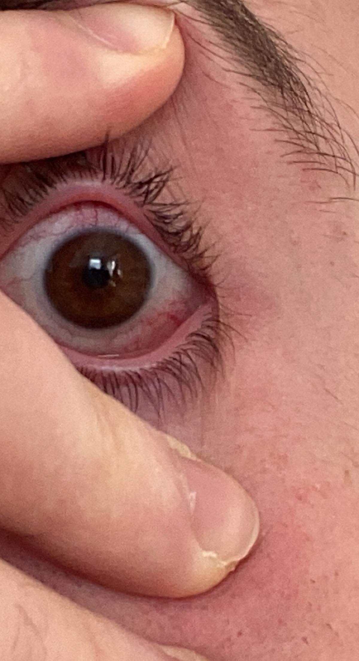 Auge sieht so aus mit Kontaklinsen? (Augen, Kontaktlinsen) Auge sieht so aus mit Kontaklinsen? (Augen, Kontaktlinsen)