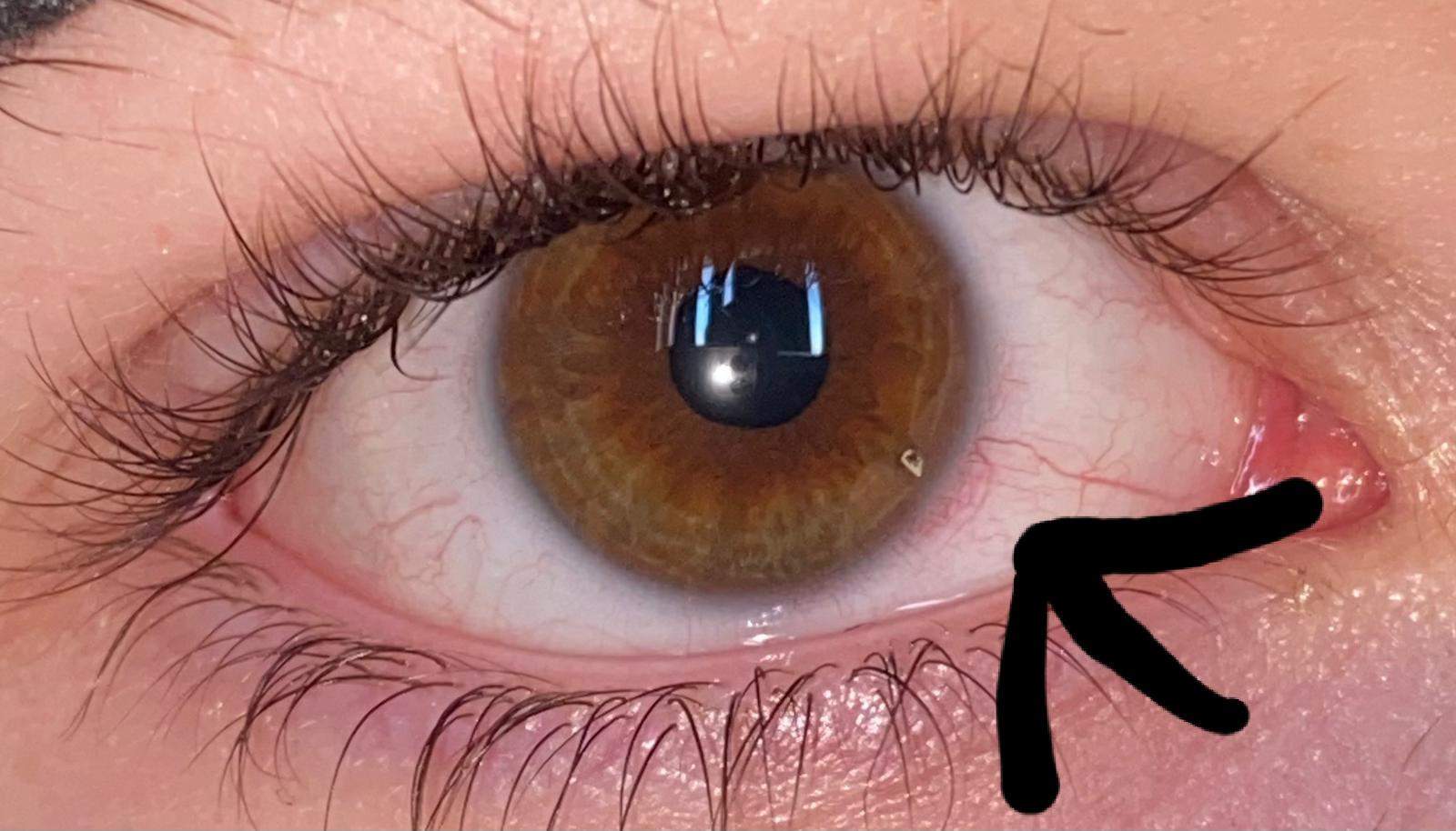 Auge tut weh was ist das? (Gesundheit und Medizin, Augen)