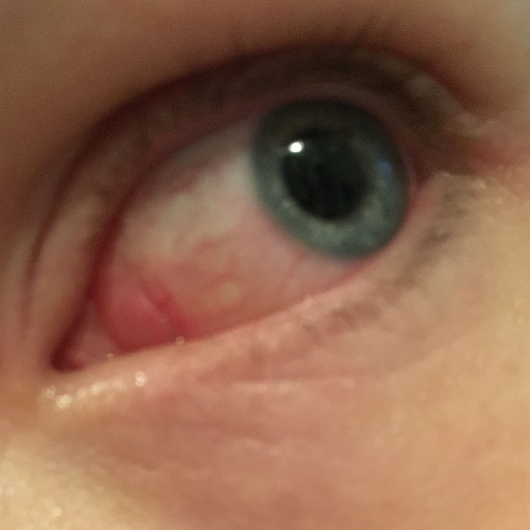Augen Brennen Jucken Tranen Und Sind Total Rot Wer Hat Einen Rat Fur Mich Allergie Juckreiz Ausschlag Augen Brennen Jucken Tranen Und Sind Total Rot Wer Hat Einen Rat Fur Mich Allergie Juckreiz Ausschlag