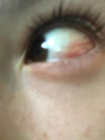 Augenader Geplatzt Geht Nicht Weg Gesundheit Und Medizin Augen Augenader Geplatzt Geht Nicht Weg Gesundheit Und Medizin Augen