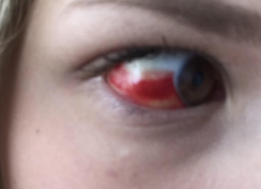 Augenarzt nötig - Adern geplatzt? (Gesundheit und Medizin, Augen)