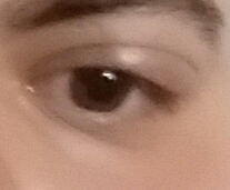 Augenlid Geschwollen Was Kann Es Sein Augen Augenlid Geschwollen Was Kann Es Sein Augen