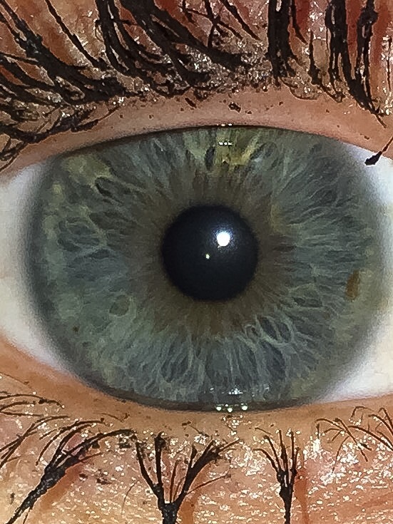 Augenherpes Ja Oder Nein Virus Herpes Augenherpes Ja Oder Nein Virus Herpes