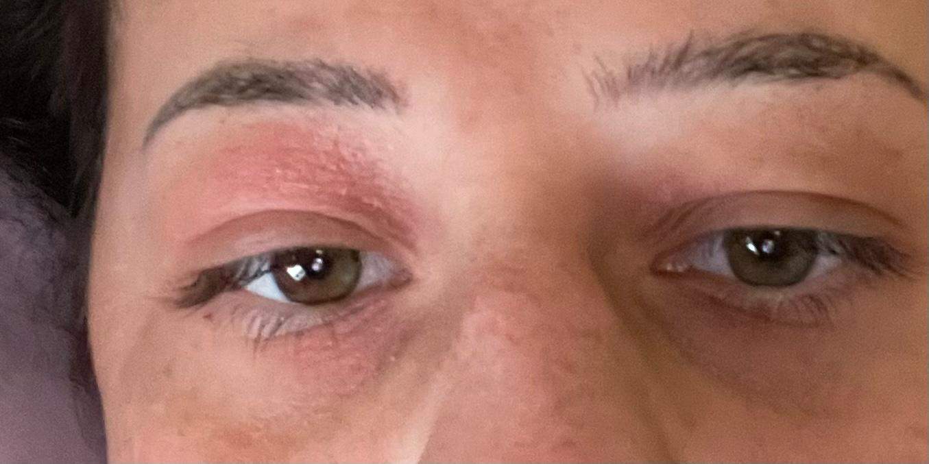 Augenlid gerötet und sehr trocken, was tun? (Gesundheit und Medizin ...