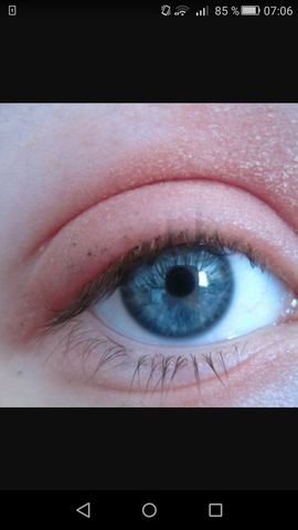 Augenlid Ist Geschwollen Augen Schwellung Augenlid Ist Geschwollen Augen Schwellung