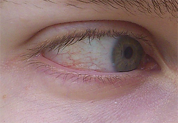 Augenproblem, trockenes Auge? Augenarzt meint nein. (Gesundheit, Augen)