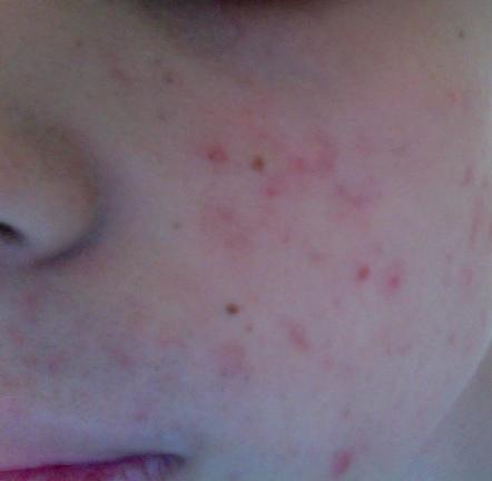 Augenringe Rote Flecken Pickel Aufgerissene Lippen Kaputte Haut Beauty Hautpflege Lippe