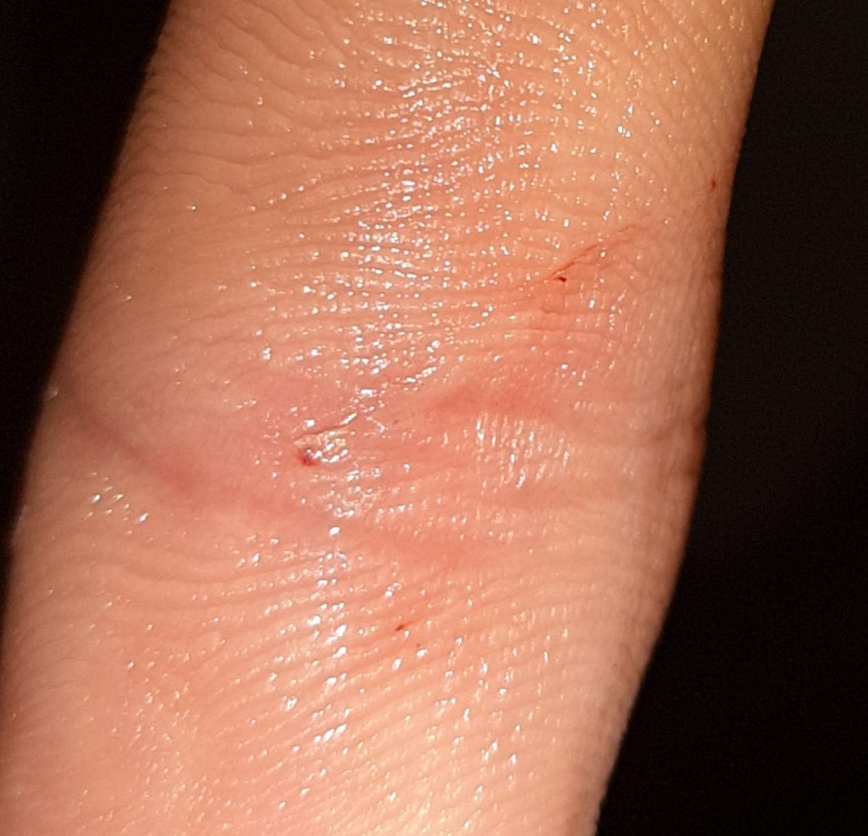 Aus Versehen an Kaktus gestochen. Was tun? (Pflanzen, Krankenhaus, Hand)