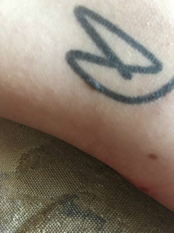 Aus Versehen Uber Das Tattoo Gelasert Haut Narben Hautarzt